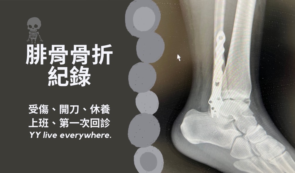 【腓骨骨折日記(接近腳踝)Part1】腓骨受傷、開刀、休養過程、注意事項總整理